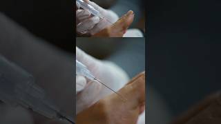 How to perform a local anaesthetic injection of the toe [upl. by Osborn510]