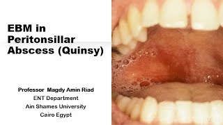 EBM in Peritonsillar Abscess Quinsy [upl. by Hazmah132]