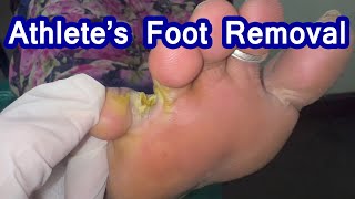 Athletes foot Removal  Fungal skin infection athletefoot [upl. by Enomis998]