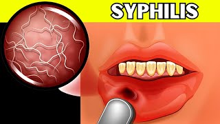 Syphilis  Causes Signs amp Symptoms Pathogenesis Diagnosis And Treatment [upl. by Granniah]