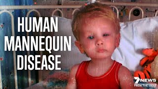 Worlds Rarest Disease The Human Mannequin  Documentary [upl. by George]