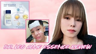 DRLEO ACNE ESSENCE REVIEW  FAKE OR ORIGINAL PAANO MALALAMAN  Alma Tu [upl. by Arabeila]