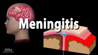 Meningitis Pathology Causes Symptoms Diagnosis and Treatment Animation [upl. by Leirza]