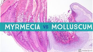 Molluscum vs Myrmecia Wart  Dermpath Lookalikes [upl. by Amethyst]