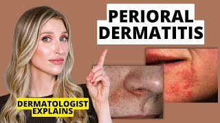 Dermatologist Explains Perioral Dermatitis What it Looks Like Causes amp Treatments  Dr Sam Ellis [upl. by Rosenblast]