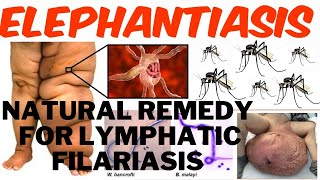 HOW TO TREAT LYMPHATIC FILARIASIS ELEPHATIASIS AND THE BEST NATURAL HOME REMEDY FOR TREATMENT [upl. by Asirral]