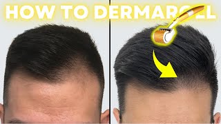 How to Derma Roll for Quickest Hair Results StepbyStep Guide [upl. by Nydia]