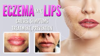 Eczema on lips causes symptoms treatment remedies prevention  Lip dermatitis Lip Cheilitis [upl. by Gnehc216]