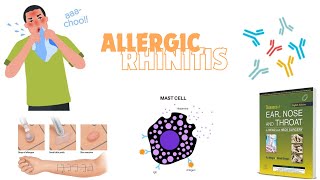 ALLERGIC RHINITISSEASONAL OR PERENNIALEARLY OR DELAYED udaipurwala dhingra otorhinolaryngology [upl. by Aitnom909]