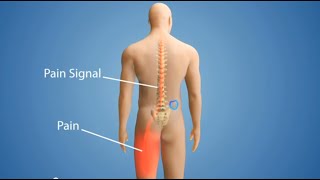 How a Pain Pump System Delivers Medication [upl. by Salzhauer]