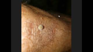 Dry Skin Why  Morgellons Decease  The silent pandemic  Aspergillus Fumigatus [upl. by Dar]