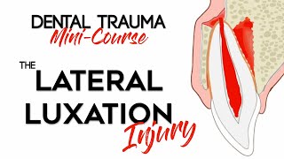 Dental Trauma MiniCourse  Part 9  Dental Trauma Guide  The Lateral Luxation Injury [upl. by Cal]