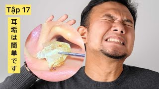 耳垢は簡単です Big earwax earwax earwaxcleaner earwaxremoval [upl. by Edmonda]