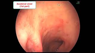 Oesophagogastroduodenoscopy OGD [upl. by Notgnimer]