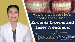 “How did we boost hes confidence using Zirconia Crowns and Laser Treatment” [upl. by Ayeki]