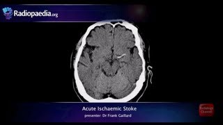 Stroke Acute infarction  radiology video tutorial CT MRI angiography [upl. by Akenal]