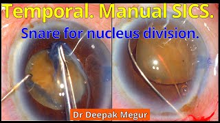 Manual SICS and minimal Surgical Induced Astigmatism  Dr Deepak Megur [upl. by Mcmillan]