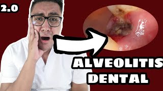 ALVEOLITIS DENTAL2 QUE HACER EN EL 2020 ¿INFECCIÓN DESPUÉS DE UNA EXTRACCIÓN [upl. by Zetana]