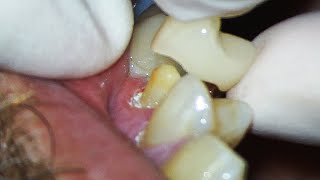 Dental Crown EXPLAINED and how much Tooth Youll Lose [upl. by Belicia]