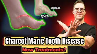 Charcot Marie Tooth Disease  Symptoms amp NEW Treatments 2024 [upl. by Virge]