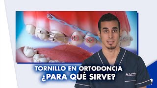 MICROTORNILLOS en ortodoncia  ¿Siempre se ponen ¿Para qué sirven  Shorts [upl. by Nivrad]