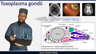 Toxoplasma gondii  Toxoplasmosis clinical features diagnosis and treatment [upl. by Schilit]