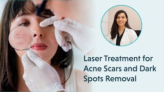 Laser Treatment for Acne Scars  Laser Treatment for Dark Spots Removal [upl. by Cedric]