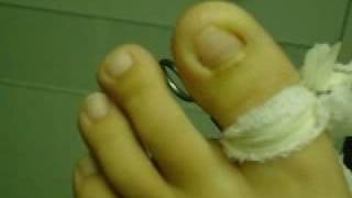 The Removal of an Ingrown ToeNail [upl. by Ayadahs234]