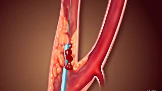 Voyage Through the Veins An Animated Exploration of Carotid Angioplasty and Stenting [upl. by Ori950]