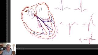 Trifascicular Block Explained Simply – WHY WHEN HOW [upl. by Atiuqer232]