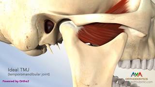 TMJ Disorder or TMD  Clicking and Closed Lock [upl. by Giselbert]