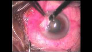 Pterygium Excision with AMG [upl. by Inaliel671]