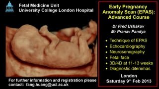 Early Pregnancy Anomaly Scan at 1113 weeks ISUOG Approved Course [upl. by Harlene791]