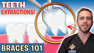 BRACES 101 Tooth Extractions For Braces  Treatment Minute Talk [upl. by Esinehc]