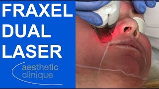 Fraxel Dual Laser  NonAblative Laser Resurfacing for Pigment and Precancers [upl. by Ailegnave56]