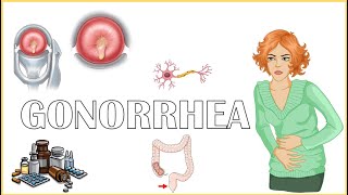 Gonorrhea  Causes Signs amp Symptoms Diagnosis And Treatment [upl. by Hakvir]