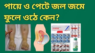 Bipedal Edema and Ascites treatment [upl. by Airdua]