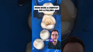 Watch how a dentist does a filling shorts [upl. by Avek]