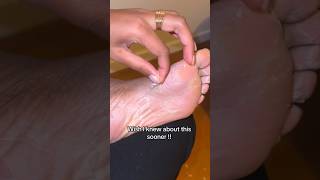 How to get rid of dry and callused feet with Plantifique Foot Peel Mask Insane Foot Peeling shorts [upl. by Hareehahs]