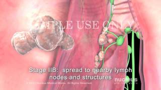 Lung Cancer Staging NonSmall Cell [upl. by Loresz]