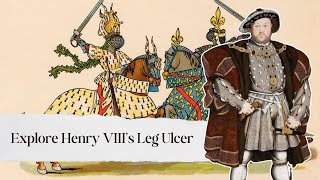 All You Need to Know About Henry VIIIs Ulcerated Leg [upl. by Garlaand94]