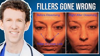 Under Eye Fillers Gone Wrong How to Fix Them [upl. by Anaeli]