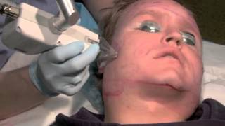 Fraxel Laser Subcision Acne Scar Treatment [upl. by Dich]