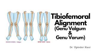 Tibiofemoral Alignment  Genu valgum  Genu varum [upl. by Madison]