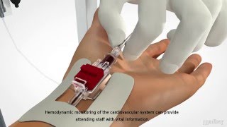 MEDBAR  Arterial Cannula [upl. by Mukerji]