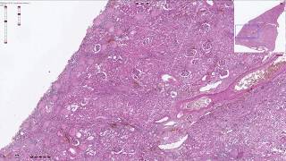 Benign Nephrosclerosis  Histopathology [upl. by Pearson585]