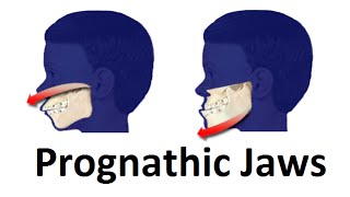 Treatment of Prognathic Jaw Jaw Pushing Forward by Prof John Mew [upl. by Veradis278]