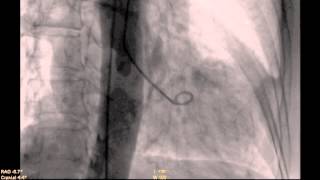 Takotsubo Cardiomyopathy [upl. by Vita]