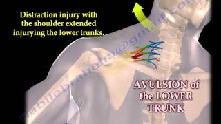 Brachial Plexus Mechanism Of Injury  Everything You Need To Know  Dr Nabil Ebraheim [upl. by Partridge74]