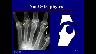 imaging in Osteoarthritis [upl. by Anwaf]